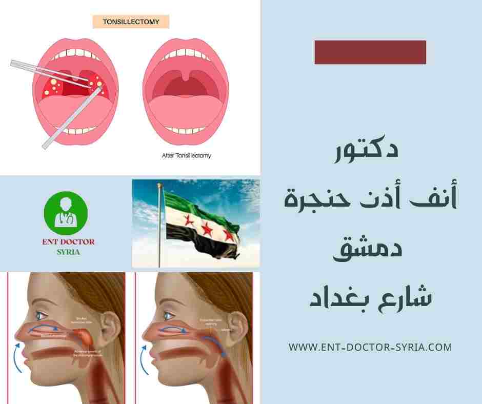 دكتور أنف أذن حنجرة دمشق شارع بغداد