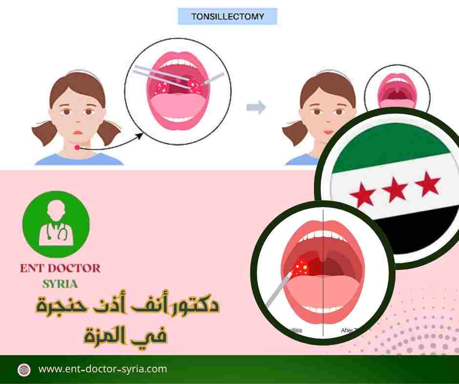 دكتور أنف أذن حنجرة في المزة