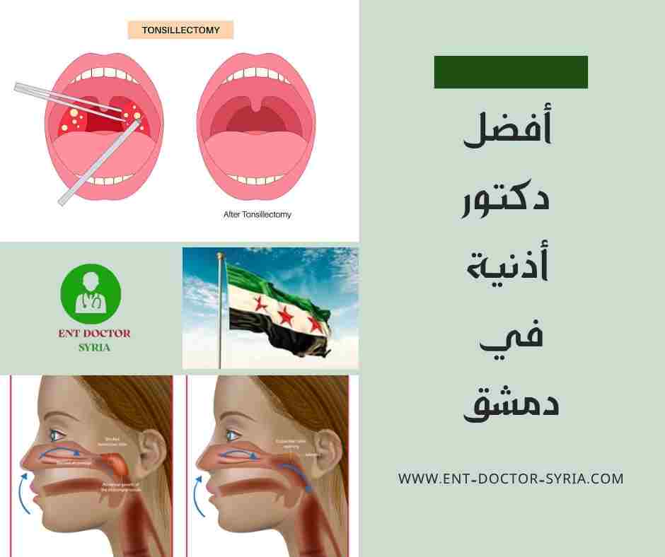 أفضل دكتور أذنية في دمشق